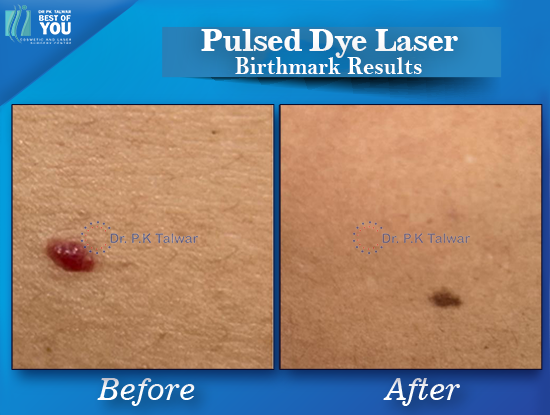 Pulsed Dye Laser Result